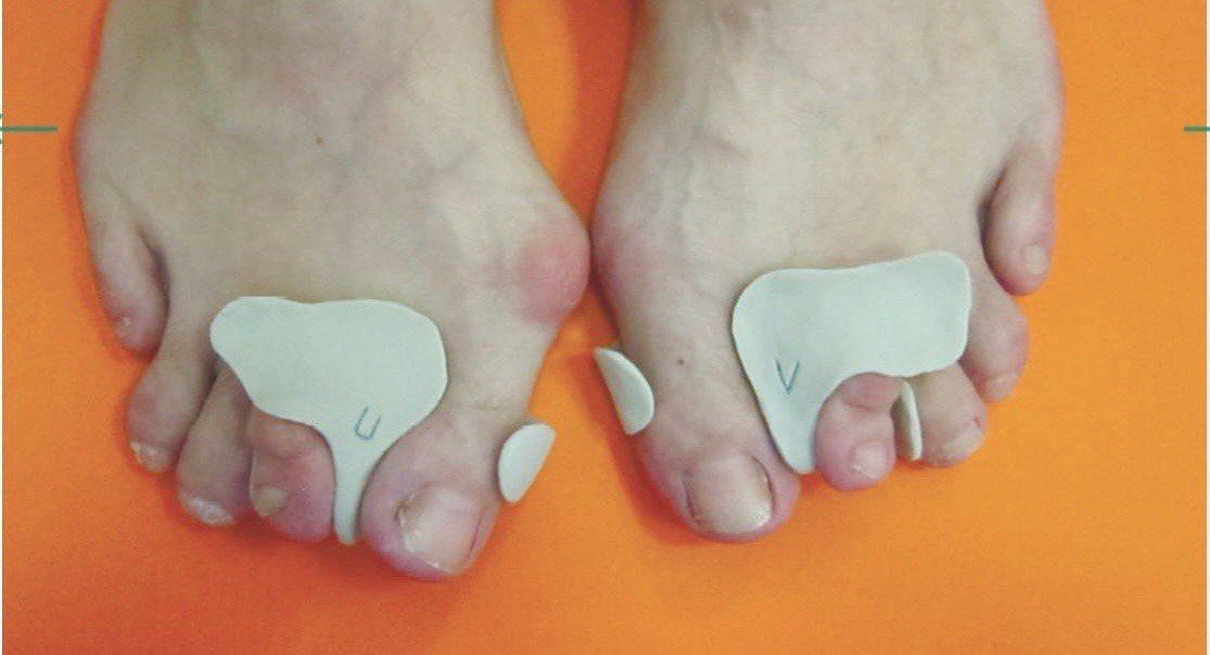 Новинка! Подологические ортозы для коррекции деформированной стопы