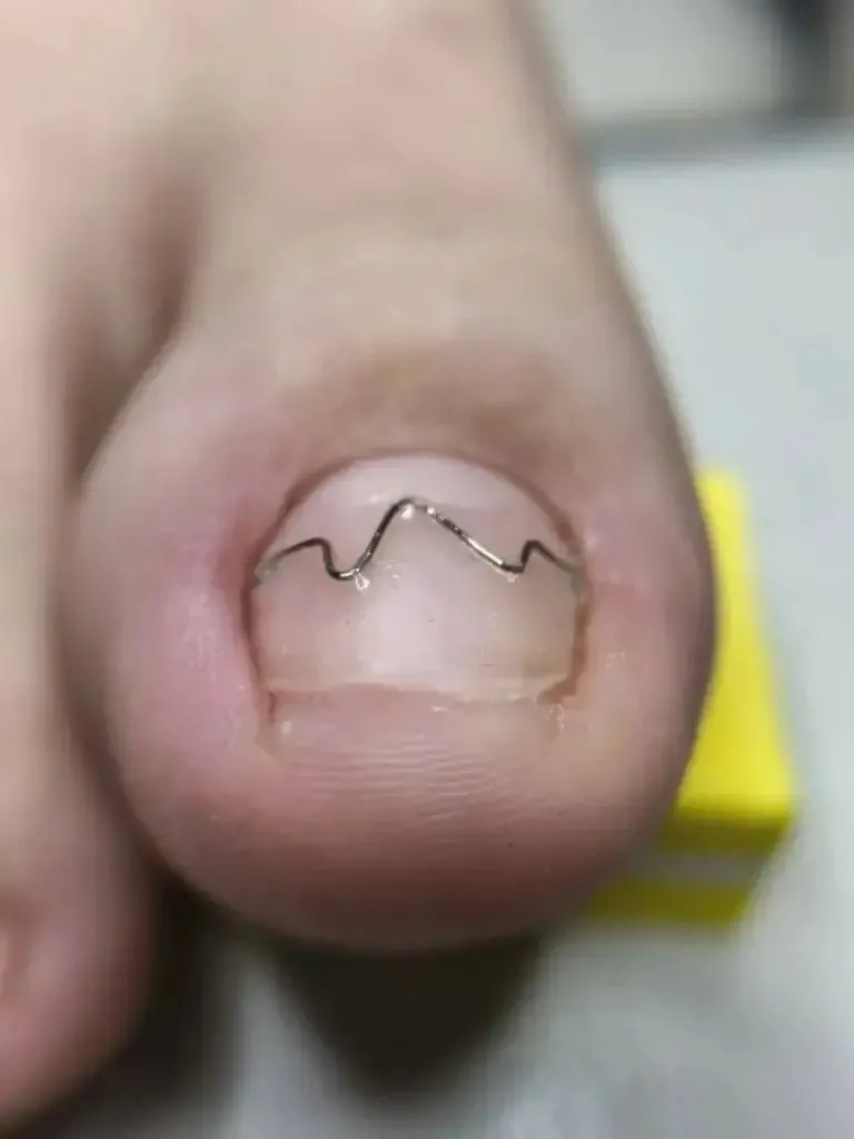 Подолог Пацеля Оксана Алексеевна прошла обучение по восстановлению ногтей на системе UniBrace в Москве!